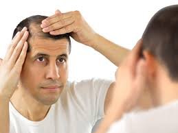 米诺地尔 2.5mg 与非那雄胺 1mg 在 Minoxytop F 2.5/1 中如何协同治疗脱发